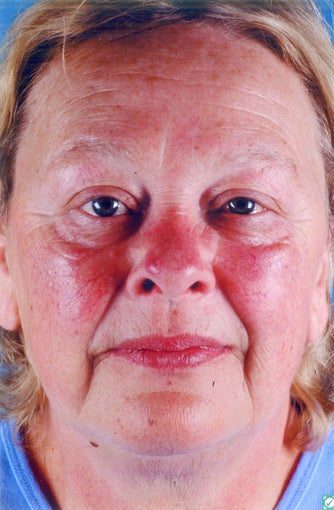 Photofacial (Intense Pulsed Light) before 660734