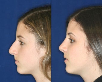 Nose Surgery before 1430628