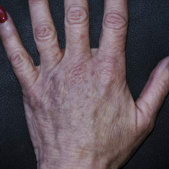 55-64 year old woman treated with Fat Transfer to Hands after 3592823