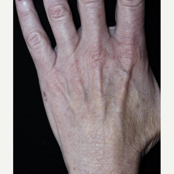 55-64 year old woman treated with Fat Transfer to Hands before 3592823