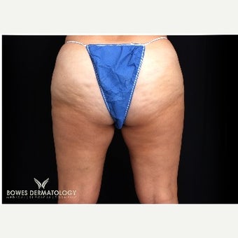 35-44 year old woman treated with Cellulite Treatment before 1801125