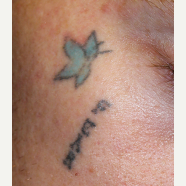 25-34 year old man treated with Tattoo Removal before 3122593