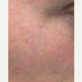 25-34 year old man treated with Tattoo Removal after 3122593