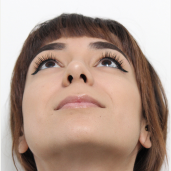 18-24 year old woman treated with Rhinoplasty after 3372970