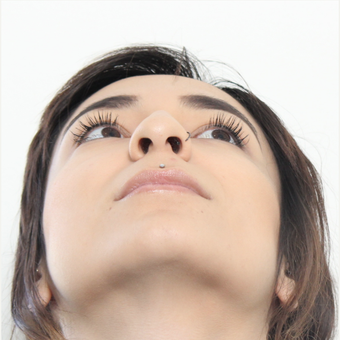 18-24 year old woman treated with Rhinoplasty before 3372970