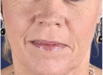 Nasolabial Folds before 1357235