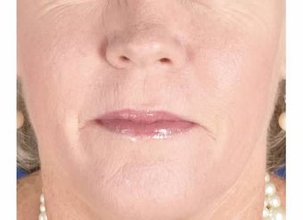 Nasolabial Folds after 1357235