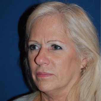 55-64 year old woman treated with Facelift before 2976963