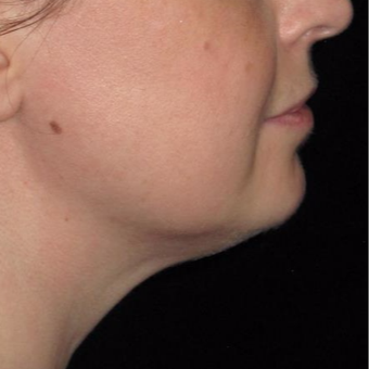 39 year old woman treated with Kybella after 3782628