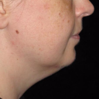39 year old woman treated with Kybella before 3782628
