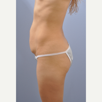 25-34 year old woman treated with Tummy Tuck before 3610483