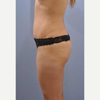 25-34 year old woman treated with Tummy Tuck after 3610483