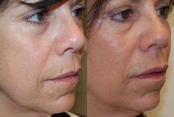 Lip Augmentation and Wrinkle Reduction with Silikon-1000. before 1364662