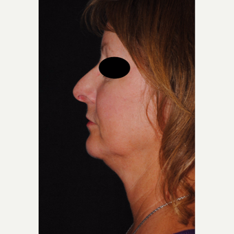 Autologous Fat Transfer and Precision TX facial liposuction to lower third of face before 3433726