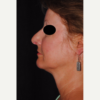 Autologous Fat Transfer and Precision TX facial liposuction to lower third of face after 3433726