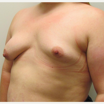 Breast Lift with Implants for a Young Woman with Tuberous Breasts & Breast Asymmetry before 3387196