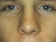 Male patient who underwent nose surgery after 932134
