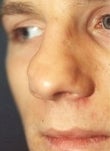 Male patient who underwent nose surgery 932134