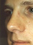 Male patient who underwent nose surgery 932134