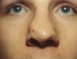 Male patient who underwent nose surgery before 932134