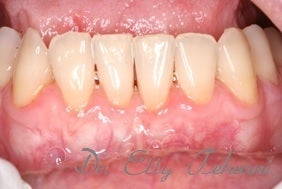 25-34 year old woman treated with Alloderm Graft after 2834258