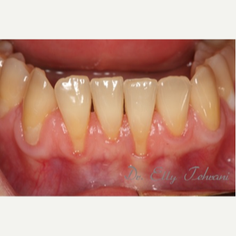 25-34 year old woman treated with Alloderm Graft before 2834258