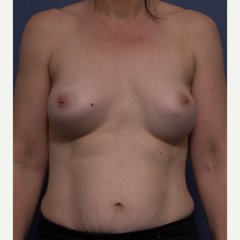35-44 year old woman treated with Breast Implant Revision before 3766862