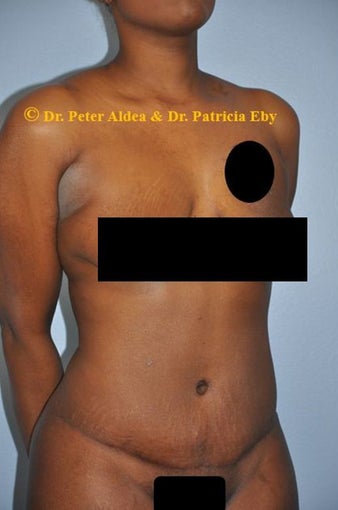 37 year old woman treated with Full Tummy Tuck and Lifting of the Mons and Upper Thighs after 2680117