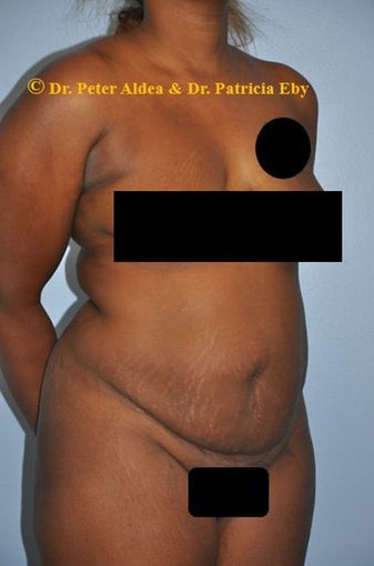 37 year old woman treated with Full Tummy Tuck and Lifting of the Mons and Upper Thighs before 2680117