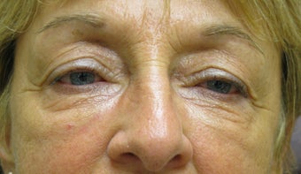 Filler for under eye hollows (IOH) after 142244