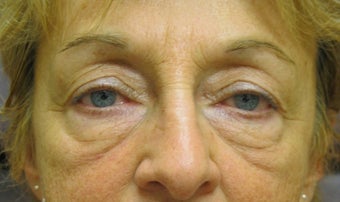 Filler for under eye hollows (IOH) before 142244