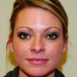 Botox after 1605463