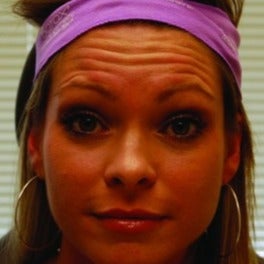 Botox before 1605463