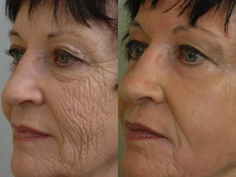 Deep Peel after 472190