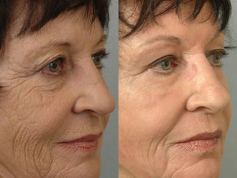 Deep Peel 472190