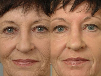 Deep Peel before 472190