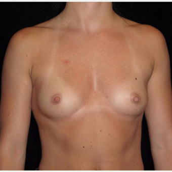 27 year old woman treated with Breast Augmentation before 3802746