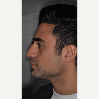18-24 year old man treated with Rhinoplasty 6 weeks post-op before 3500138