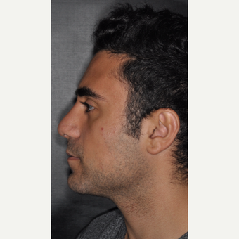 18-24 year old man treated with Rhinoplasty 6 weeks post-op after 3500138