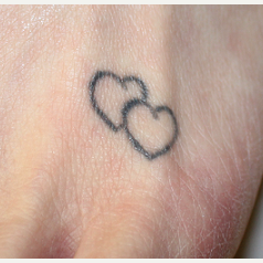 Tattoo Removal Treatments for this 39 Year Old Woman before 3241460