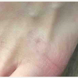 Tattoo Removal Treatments for this 39 Year Old Woman after 3241460