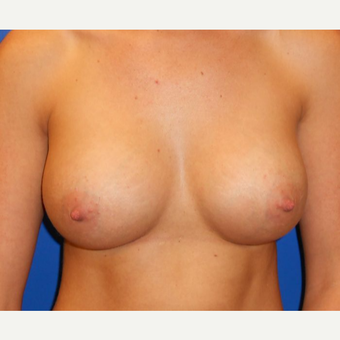 25-34 year old woman treated with Breast Implants after 3669650