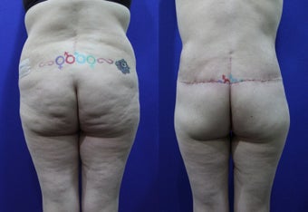 46 Year Old Treated for Abdominal Apron & Sagging Buttocks before 1109100