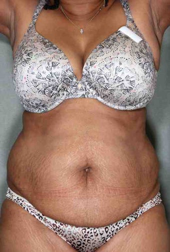 50 Year Female Liposuction Upper/Lower Abs before 1046606