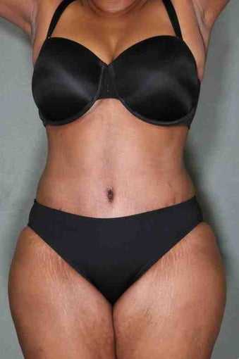 50 Year Female Liposuction Upper/Lower Abs after 1046606