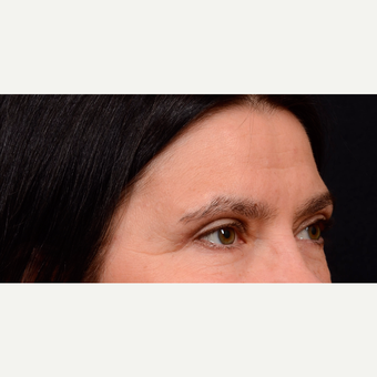 55-64 year old woman treated with Brow Lift after 3776195