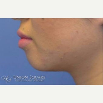 Chin enhancement using Restylane filler before 2168625