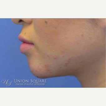 Chin enhancement using Restylane filler after 2168625