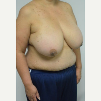 55-64 year old woman treated with Breast Reduction and liposuction of the axilla before 3383015