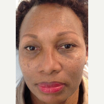 45-54 year old woman treated with Mole Removal after 3459311